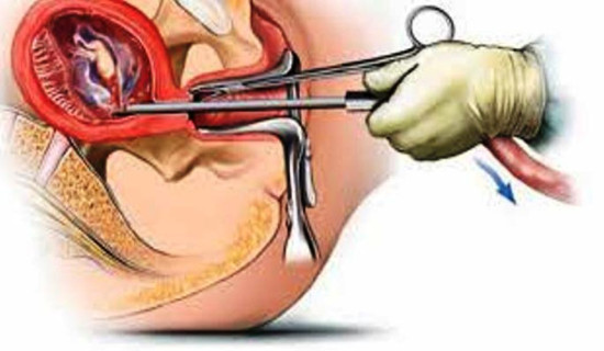 समयमै उपचार गरे निको हुन्छ बालबालिकाको आँखामा हुने क्यान्सर