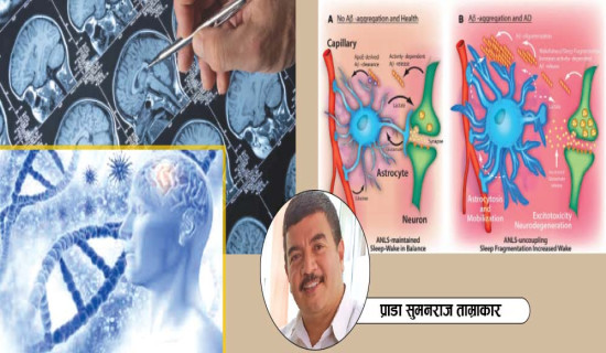 बिर्सने रोग अल्जाइमर्स