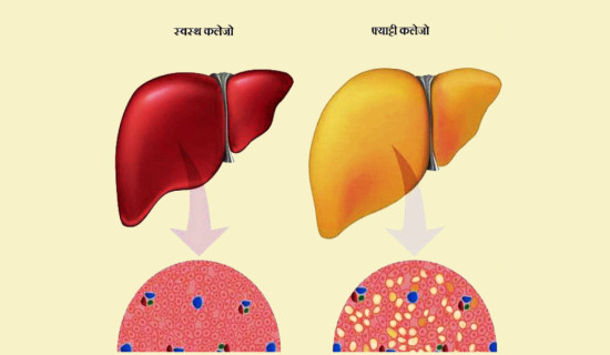 मोटोपना भए पनि कलेजो स्वस्थ रह्यो भने बालबालिका दीर्घकालीन रोगबाट सुरक्षित