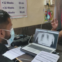 एआई एक्सरेबाट क्षयरोगीको खोजी