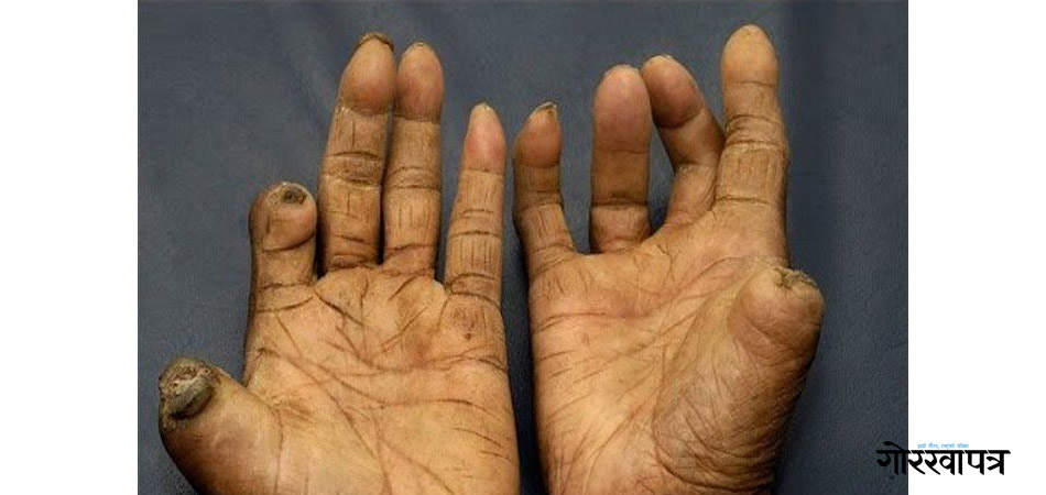 जाजरकोटमा १८ जना कुष्ठरोगी उपचारको दायरामा