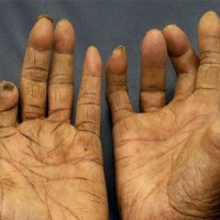 जाजरकोटमा १८ जना कुष्ठरोगी उपचारको दायरामा