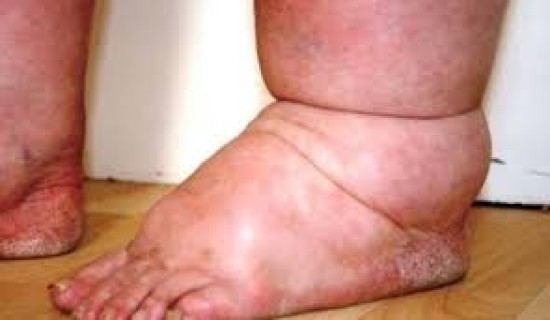 हात्तीपाइलेविरुद्धको दशदिने औषधि सेवन अभियान