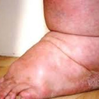 हात्तीपाइलेविरुद्धको दशदिने औषधि सेवन अभियान