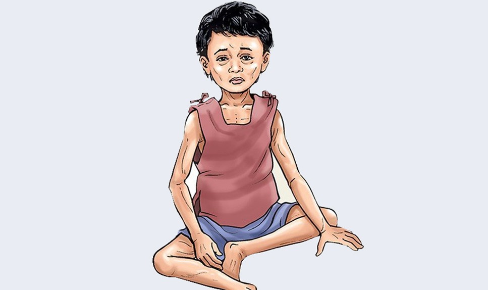 हुम्लाका कुपोषित बालबालिका जुम्लामा
